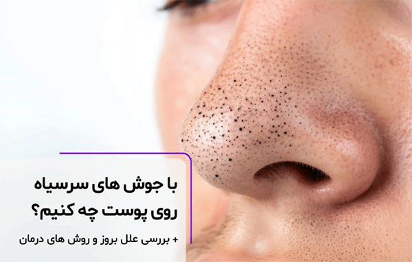 روش‌های از بین بردن و درمان منافذ باز روی بینی