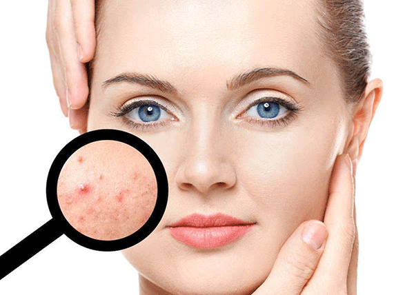 از بین بردن جای جوش و لک صورت